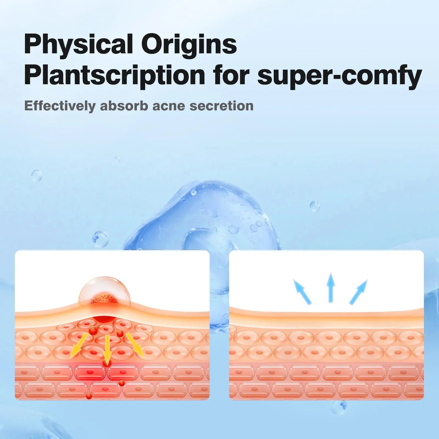 QUSTERE Pimple Patches for Face, Hydrocolloid Acne Patches